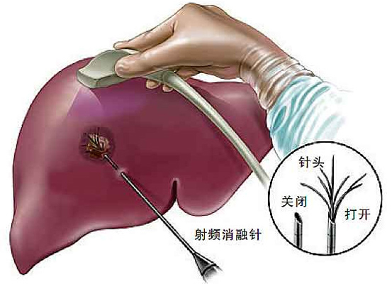 肝癌射频消融术(radiofrequency ablation rfa 感染性疾病科-山东