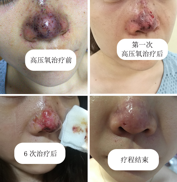 我院高压氧科成功治疗玻尿酸隆鼻术后栓塞1例