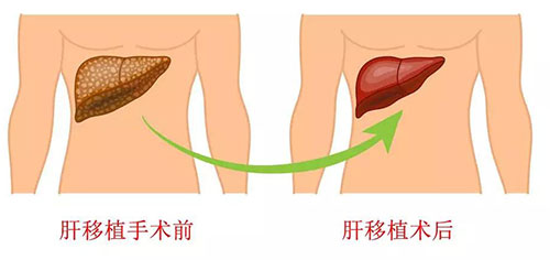 【省医专家谈健康】让人同"肝"共苦的肝移植术——山东省立医院普外科