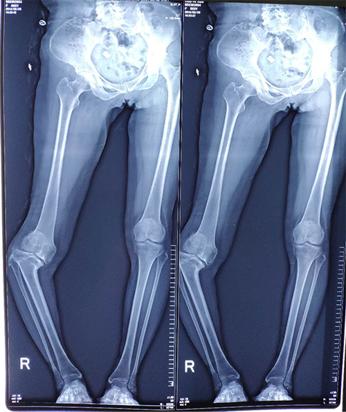 膝关节畸形疼痛40年 我院骨关节外科采用3d打印技术为其手术治疗