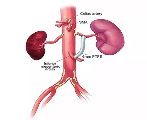 肾脏动脉解剖图图片