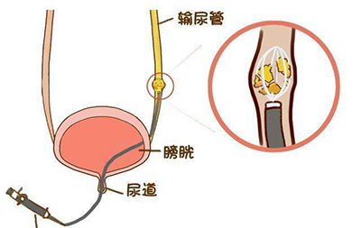 输尿管结石卡通图片图片