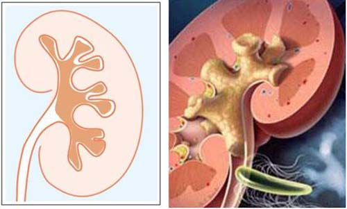 铸型肾结石图片图片
