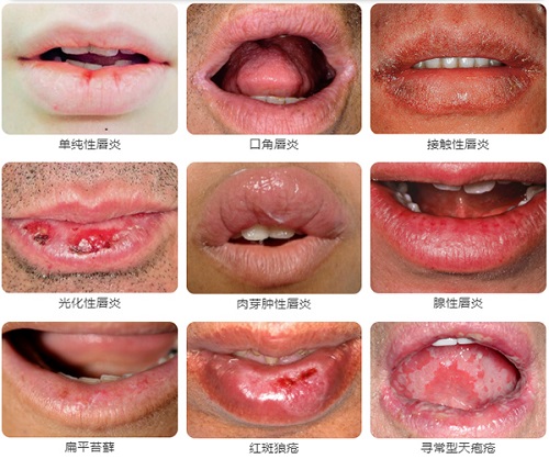 省医皮肤话美容唇炎反复怎么办省医皮肤科专家的唇炎自救指南快拿去