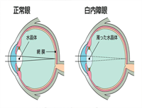 白内障