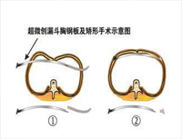 漏斗胸