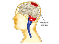 急性脑出血