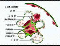 肾病综合征