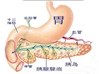 重症胰腺炎