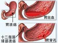 消化道出血
