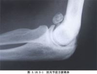 肘关节粘连