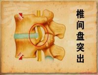 腰椎间盘突出