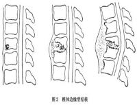 脊柱结核