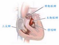 瓣膜性心脏病