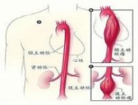 胸主动脉瘤