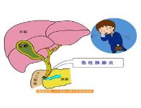 重症急性胰腺炎