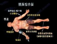挤压综合征