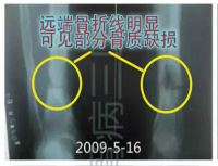 骨髓炎、骨不连