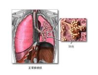 急性呼吸窘迫综合征