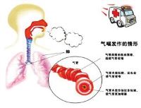 重症哮喘