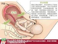 分娩期并发症