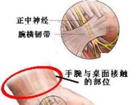 腱鞘炎（弹响指）