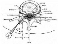 颈椎间盘突出症