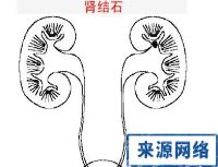 肾结石