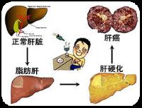 酒精性肝病