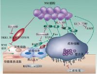 多发性骨髓瘤
