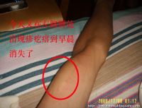 荨麻疹