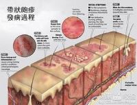 带状疱疹