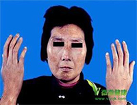 硬皮病