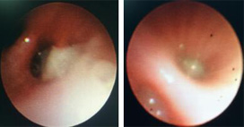 山东省立医院小儿呼吸综合科——纤维支气管镜检查术