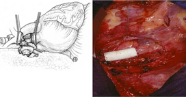 山东省立医院胸外科——无插管转流无阻断血流实施上腔静脉切除置换技术
