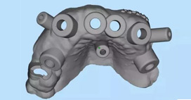 山东省立医院口腔科——数字化导板引导下的牙缺失患者即刻种植即刻修复即刻负重技术