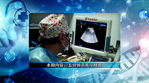 【医院电视专栏：百年省医】超声介入——五分钟杀死小肝癌