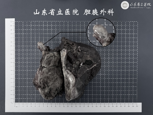 山东第一医科大学附属省立医院多学科协作成功实施巨大肝癌伴高危癌栓转化治疗